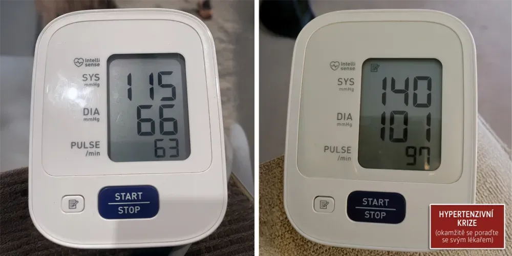 Derila sleep apnea 2 hypertensive crisis CS C SM